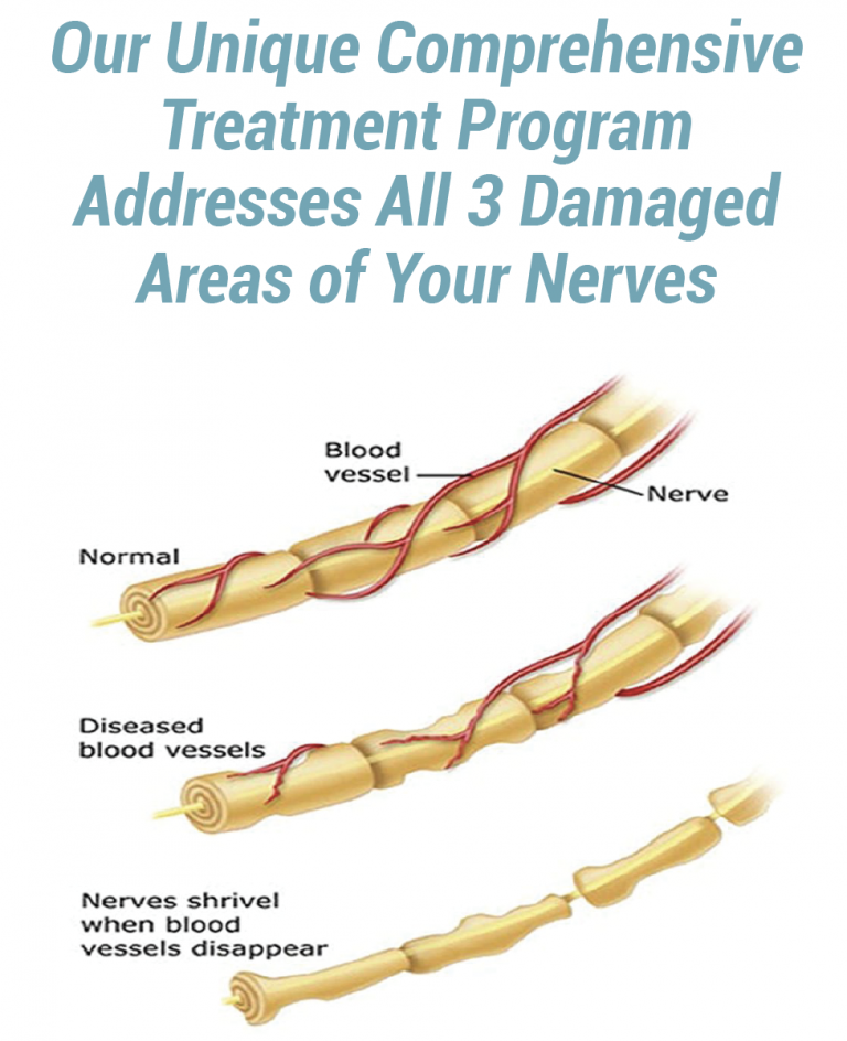 stages of neuropathy
